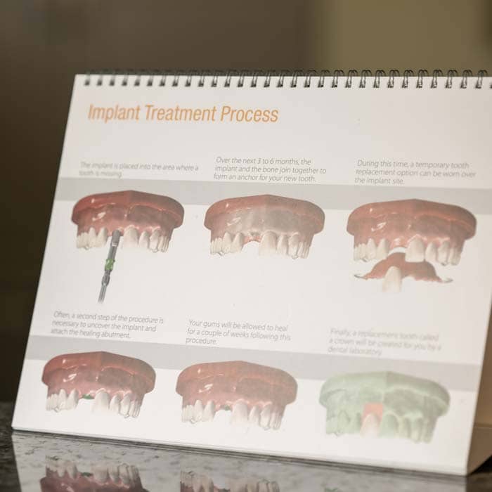 Dental Implant Grand Blanc Mi