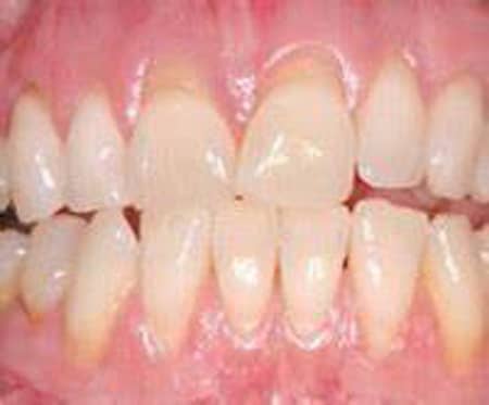 Gum Disease Therapy Portage Mi Dentist