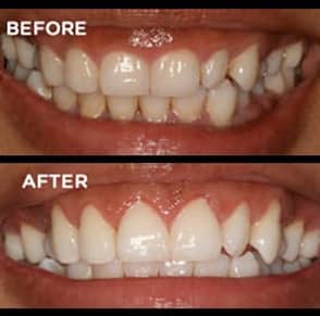 Gum Reshaping Dentist Portage Mi
