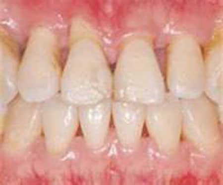 Gum Disease Treatment Portage Dentist