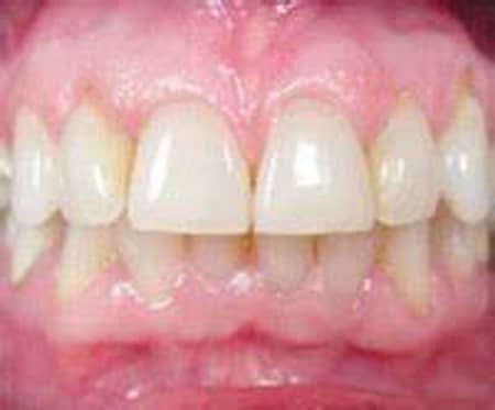 Gum Disease Treatment Portage Mi Dentist